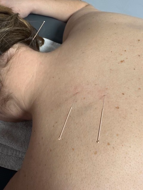 Acupuncture converted